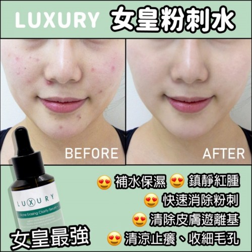 luxury acne erasing clarify serum
